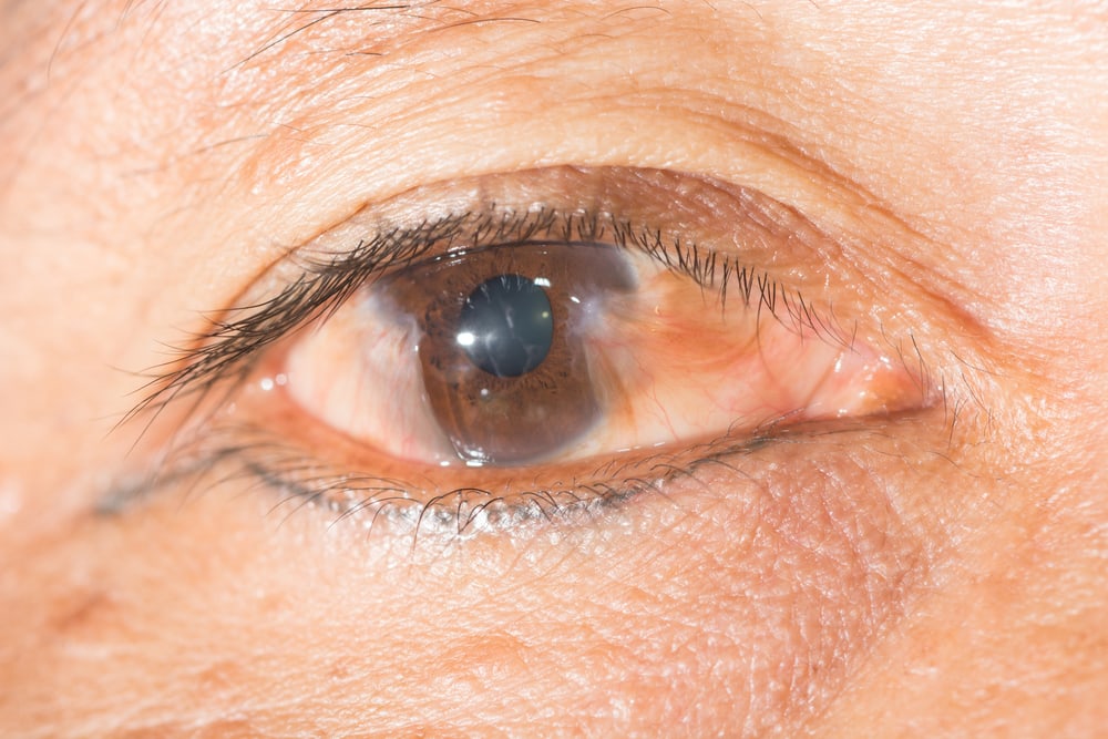 Pinguecula vs. Pterygium: What's the Difference?