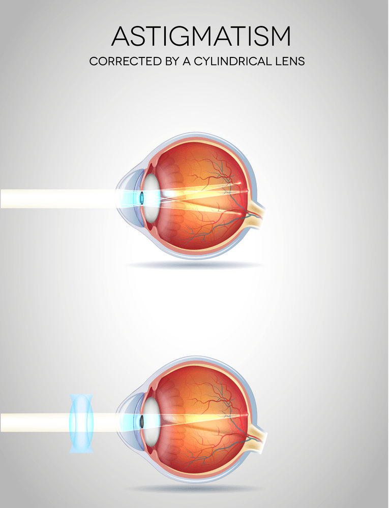 Astigmatism New Jersey Eye Center