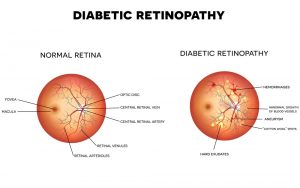 Diabetic retinopathy bergen county