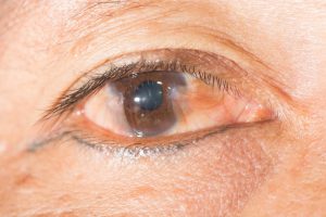 Pinguecula and Pterygium Eye care eye center glaucoma cataract vision exam retina Bergen county New Jersey
