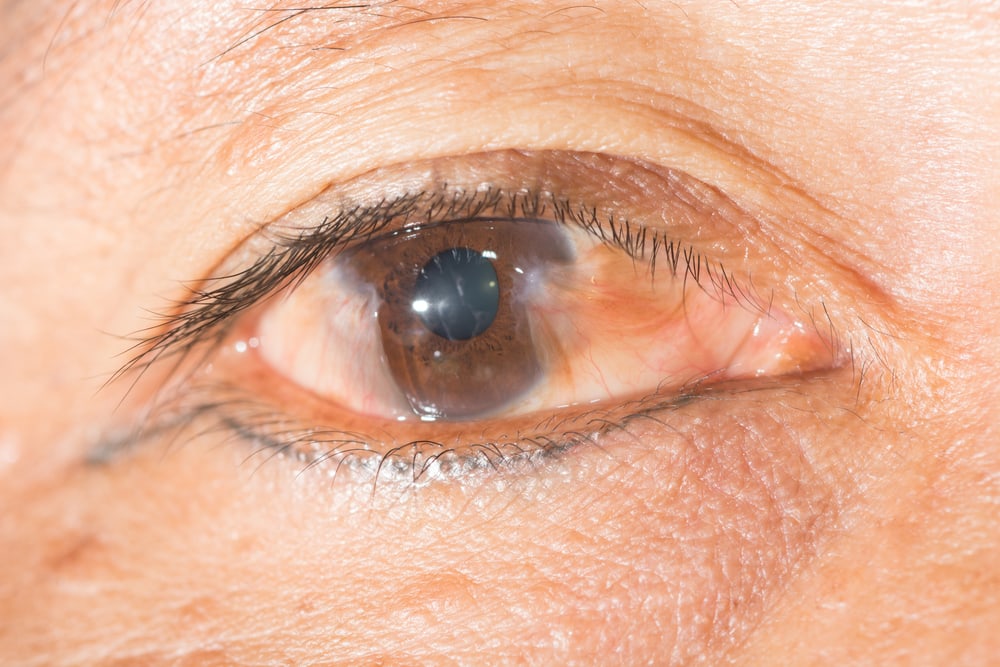 Pterygium Surgery Bergenfield NJ