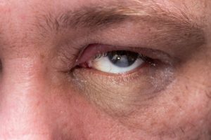 Blepharitis symptoms causes treatment new jersey