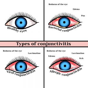 Conjunctivitis types causes treatment new jersey