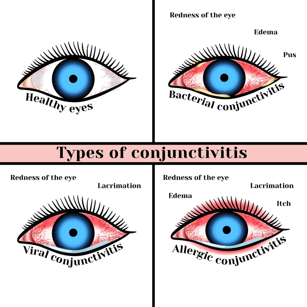 what causes conjunctivitis