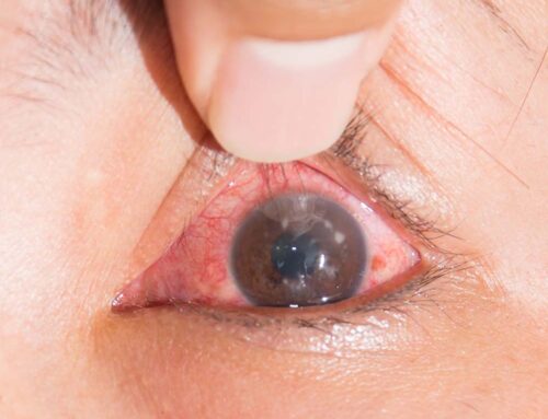 Understanding Eye Allergies: Symptoms, Causes, & Treatments
