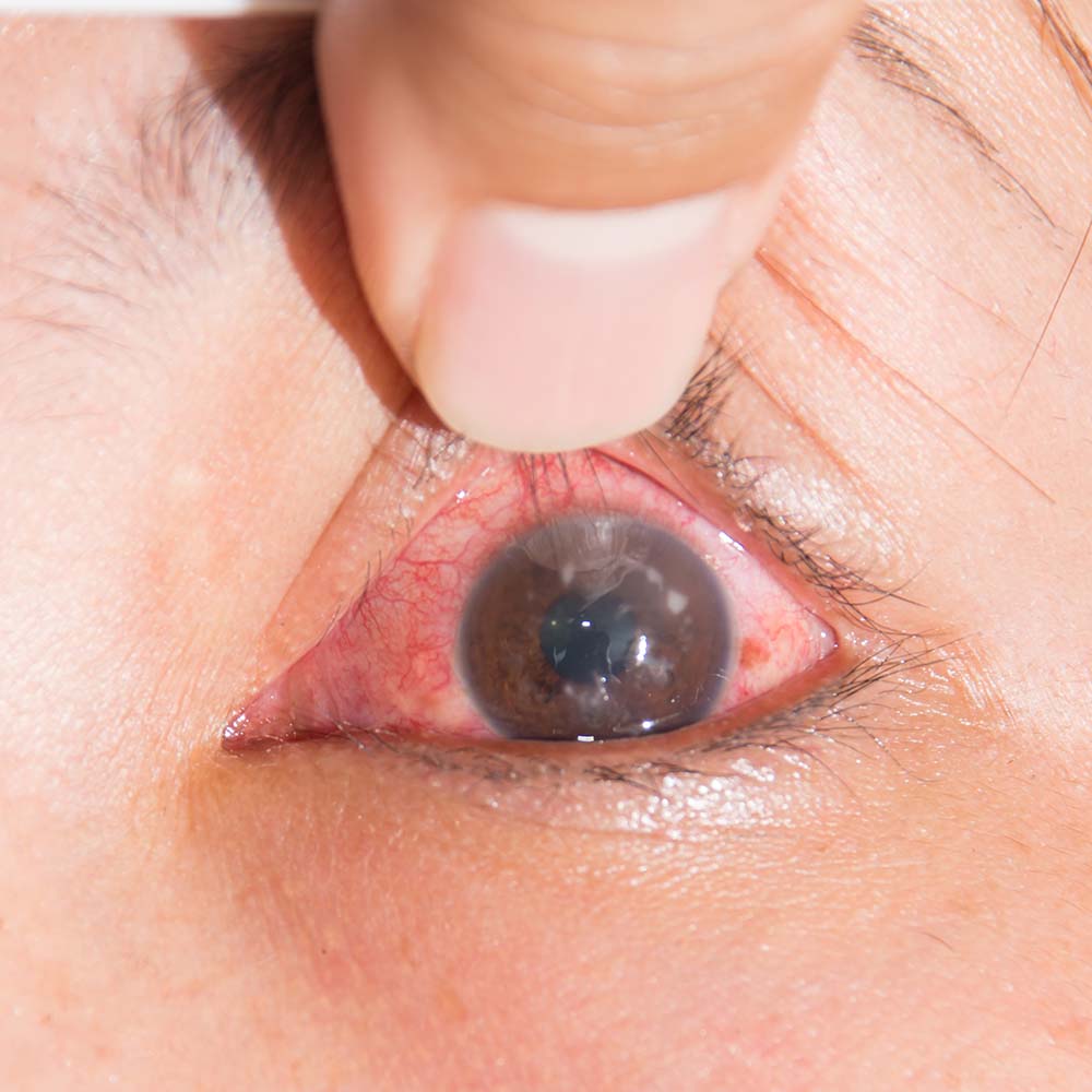 Understanding Eye Allergies: Symptoms, Causes, & Treatments