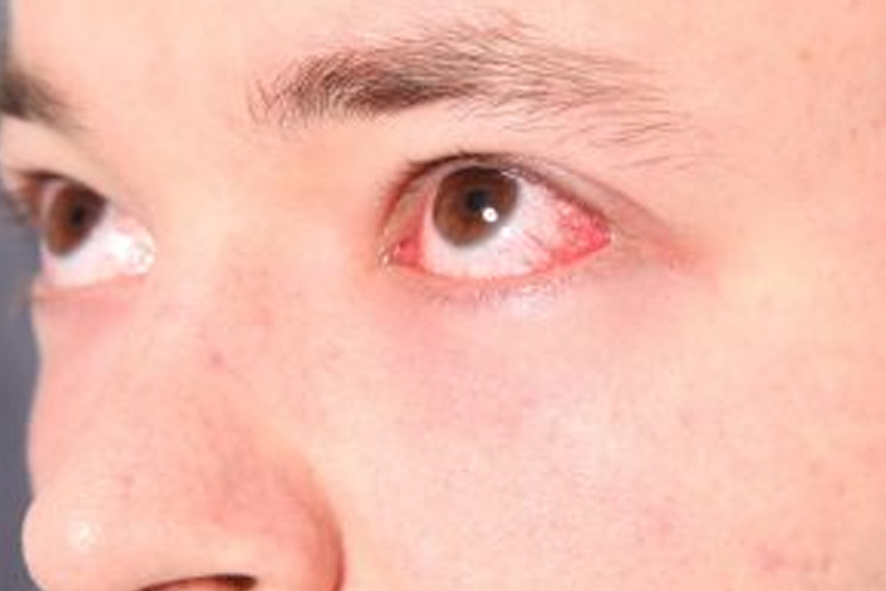 Causes and Treatments of Eye Allergies