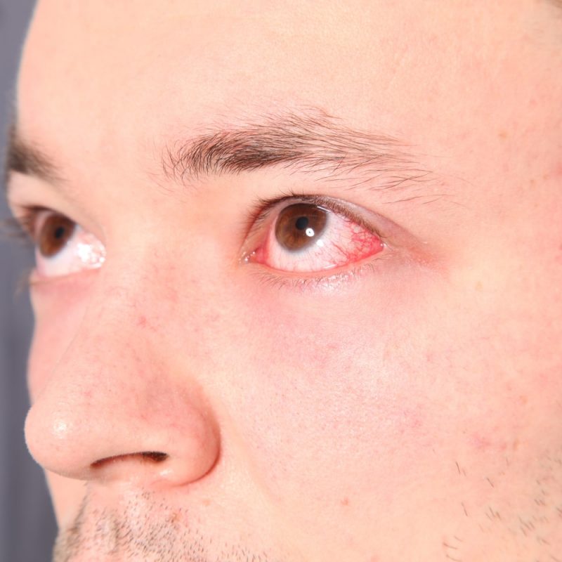 Causes And Treatments Of Eye Allergies New Jersey Eye Center