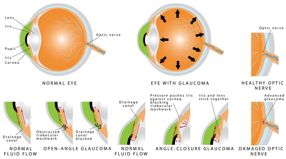 Open Angle Glaucoma causes, symptoms, prevention & treatment New Jersey