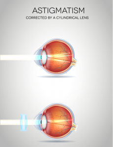 Astigmatism types, causes & treatment eye care eye center bergenfield new jersey nj