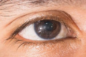 Keratitis Causes,Signs & Treatment Eye care eye center bergenfield nj