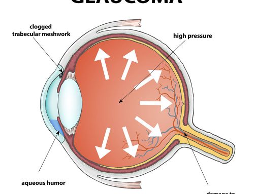 Glaucoma Prevention: Simple Steps to Take Control