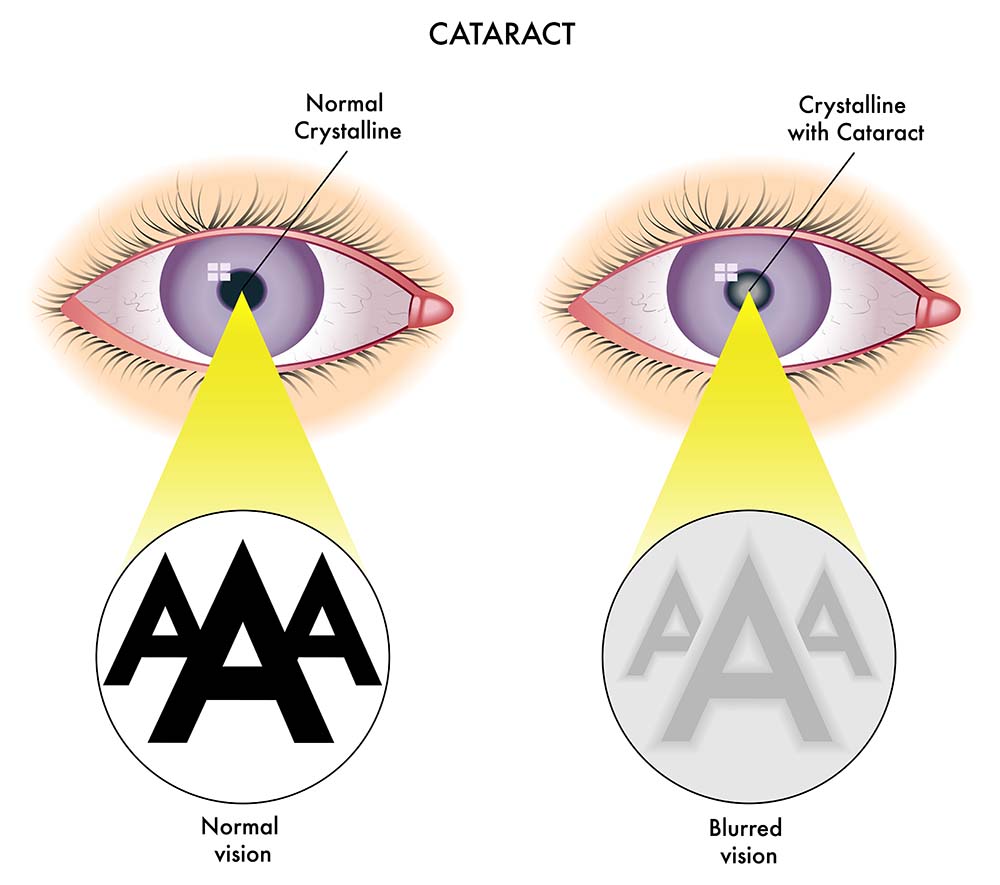 Eye Vision Plan Cost