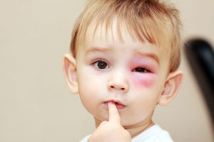 Eye injuries treatment nj eye center bergenfield