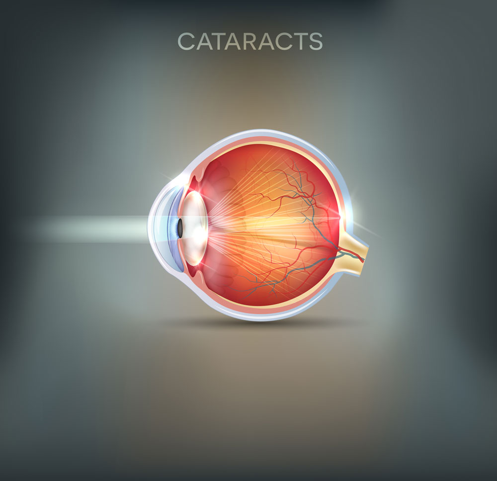 Cataract abstracts on gray background